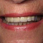 Windy City Smiles - Chicago Dentist - Implants2 1